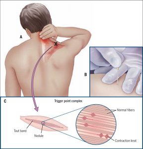 dry-needling dry-needling